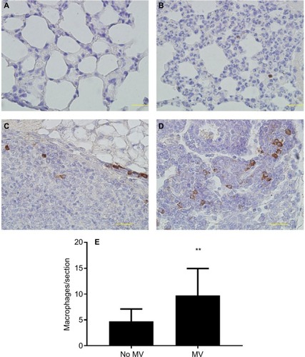 Figure 4 (A–D) Representative images of immunohistochemical staining of macrophages (CD68+) in lung tissue of BALB/c mice. In the control group (28 d after 5×105 4T1 cells were injected into the mammary fat pad, untreated with MV during surgical procedures, at 14 d after inoculation, Protocol B). CD68 expression was mainly detected in the cytoplasm. Positive staining is indicated by brown particles. (A) No CD68-positive macrophages were found in the lung parenchyma and (C) only scattered CD68-positive macrophages exist in the metastatic nodule. Bar: 50 µm. In the MV-treated group, 28 d after 5×105 4T1 cells were injected into the mammary fat pad, treated with MV during surgical procedures, and at 14 d after inoculation (Protocol B). (D) High infiltration of CD68-positive macrophages in metastatic nodules and (B) CD68-positive macrophages were also found in surrounding lung parenchyma. Bar: 50 µm. (E) Quantification of macrophages in lung tissue using CD68 antibody by immunohistochemical staining. MV exposure resulted in a significant increase in parenchymal cells that stained positive for CD68 when compared to controls. Data presented as mean±SD, n=4. **Statistical significance, P<0.01. Magnifications A-B 20x, and C-D 40x.Abbreviations: d, days; h, hours; MV, mechanical ventilation.