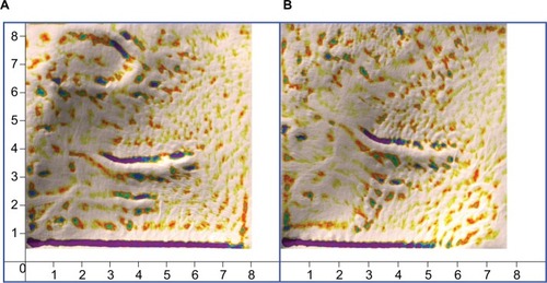 Figure 5 A photo taken by the Antera skin analysis camera of a hypertrophic scar on the face of a child before treatment (A), and after treatment (B). The upper part appears slightly elevated after treatment with 5-FU monotherapy while the lower part appears flattened after combined the approach.