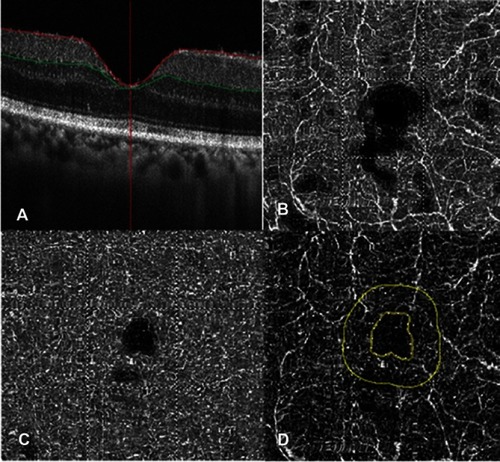 Figure 2 Macular conditions before dexamethasone implantation via optical coherence tomography angiography device. (A) Foveal thickness. (B) Superficial vessel density. (C) Deep vessel density. (D) Foveal avascular zone.