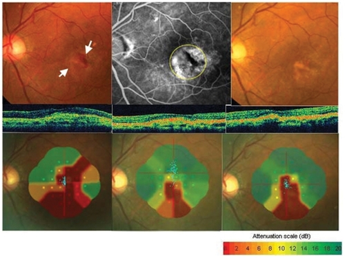 Figure 2 Fundus photographs, fluorescein angiograms, optical coherence tomographic (OCT) images, and Micro Perimeter 1 (MP1) images from a 61-year-old man (Case 1) whose visual acuity (VA) was reduced to 20/60 secondary to classic and occult choroidal neovascularization (CNV) in his left eye. Top left: Fundus photograph showing subretinal hemorrhage and classic CNV (white arrow) before treatment. Top middle: Fluorescein angiogram (FA) showing minimally classic CNV. Photodynamic therapy was performed with a 3500 im laser spot on the area indicated by the yellow dotted circle. Top right: Fundus photograph three months after photodynamic therapy (PDT) shows fibrosis of CNV and absorption of subretinal hemorrhage. VA was 20/50 at three and six months after PDT. Middle row, left: OCT image before PDT. Middle row, middle: OCT image three months after PDT showing a reduction in the size of the CNV. Middle row, right: OCT image at six months after PDT showing a reduction of foveal thickness. Bottom left: MP1 image shows a dense scotoma (not seen at 0 dB) in CNV component and subretinal hemorrhage. Mean retinal sensitivity within the central 10° is 5.0 dB before PDT. Bottom middle: Mean retinal sensitivity improved to 9.1dB at three months after PDT. Bottom right: Mean retinal sensitivity improved to 11.8 dB at six months after PDT. The patient did not report an improvement of the central visual disturbance of the left eyes. FA shows no leakage from CNV at three months after PDT.