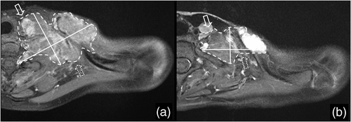 Figure 4. A representative axial T1-weighted MR image of a tumor mass at the left cervicothoracic area from a patient with a neurogenic sarcoma of the brachial plexus (a) before and (b) after EIA/RHT therapy. The tumor boundaries are irregularly shaped which is typical for sarcomas. Therefore, a homogeneous tumor shrinkage in all spatial directions could not be assumed, especially in the anterior-medial (solid arrows) and posterior-lateral (dotted arrows) parts of the tumor. Volumetric criteria yielded a partial response whereas application of RECIST and WHO criteria resulted in stable disease.