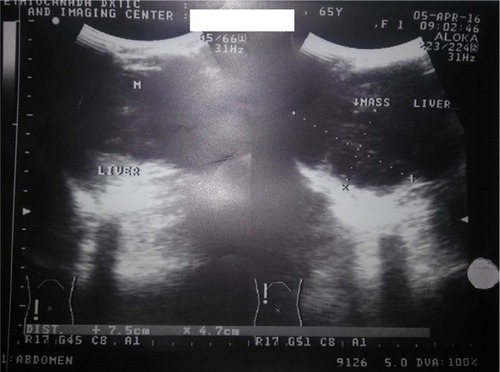 Figure 2 Ultrasound of abdomen showing a liver mass.