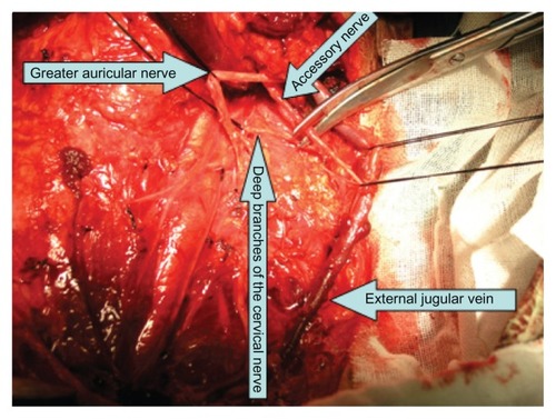 Figure 2 The patient was treated with NRND before the accessory nerve was dissected.