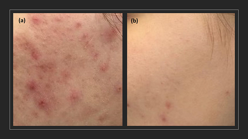 Figure 3 Acne severity (a) before treatment and (b) after treatment of oxybrasion and cosmetic acids in group B.