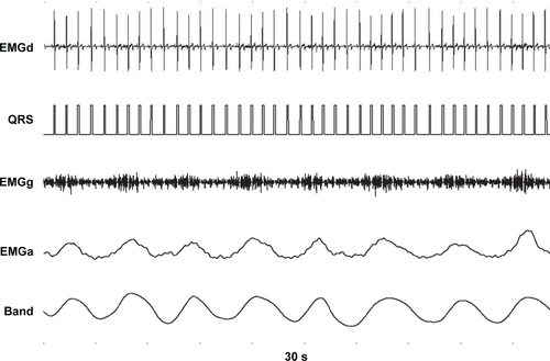 Figure S1 The QRS removal process.Notes: The averaged EMG (EMGa) shows respiratory activity. As control the signal from the abdominal magnetometer band (Band) is shown. From the diaphragmatic EMG signal (EMGd), the QRS complex was detected and stretched into a standard QRS pulse with a duration of 100 ms (QRS). During the QRS pulse a cut was made in the slightly delayed (40 ms) EMG signal to completely filter out the QRS complex (EMGg). Next, the gated EMG was rectified and averaged with a moving time window of 200 ms. Finally, the missing signal in the gate was filled with the running average resulting in a fairly good interpolation during the gate and an almost QRS-free averaged EMG signal (EMGa).Abbreviation: EMG, electromyography.