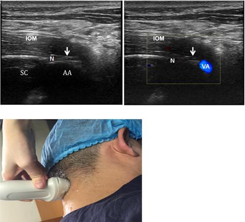 Figure 2 Short-axis sonogram at the level of AA joint (top left and top right). The white arrows show the atlantoaxial joint (top left and top right). Technique of how to do the US on the patient (bottom). Reproduced from Li J, Yin Y, Ye L, Zuo Y. Pulsed radiofrequency of C2 dorsal root ganglion under ultrasound guidance for chronic migraine: a case report. Journal of Pain Research. 2018;11:1915–1919. Copyright © 2018 Li et al.Citation10Abbreviations: VA, vertebral artery; N, C2 nerve root and dorsal root ganglion; AA, atlantoaxial joint; SC, spinal cord; IOM, inferior oblique muscle.