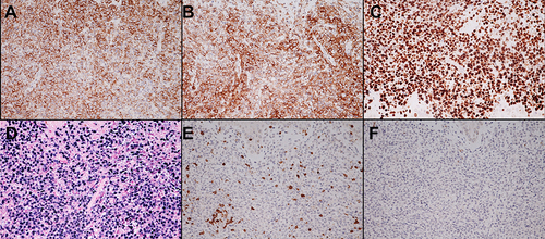 Figure 4 Immunohistochemistry of cutaneous methotrexate-related Epstein-Barr virus (EBV)-positive diffuse large B-cell lymphoma shows positive (A) CD20, (B) CD30, (C) Ki-67 (>90%), and (D) EBV encoded RNA by in situ hybridization (EBER-ISH) but negative (E) CD3 and (F) CD 56 staining of atypical lymphoid cells (H&E ×400).