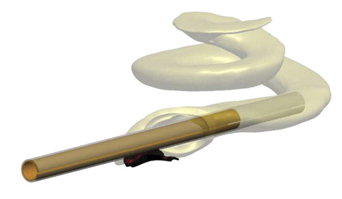 Figure 9. Three-dimensional model of the scala tympani with sheath inserted via an inferior-anterior cochleostomy.