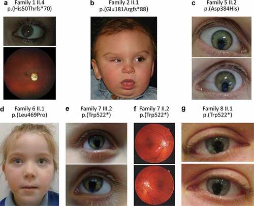 Figure 3. Phenotypic images for individuals from families 1, 2, 5, 6, 7, and 8. (a) images of Individual 1 (Family 1 II.4) showing left microphthalmic eye and iris coloboma (top), and fundoscopy of the right eye (bottom) (b) photograph of Individual 2 (Family 2 II.1) showing bilateral microphthalmia and iris coloboma. (c) images of both eyes of Individual 5 (Family 5 II.2) showing bilateral iris colobomas. (d) photograph of Individual 6 (Family 6 II.1) showing bilateral iris colobomas. (e) images of both eyes of Individual 7 (Family 7 III.2) showing bilateral iris colobomas. (f) fundoscopy images of the father of Individual 7 (Family 7 II.2) with bilateral cavernous disc anomalies indicated by an arrow (top—right eye, bottom—left eye). (g) images of both eyes of Individual 8 (Family 8 II.1) showing bilateral iris colobomas.
