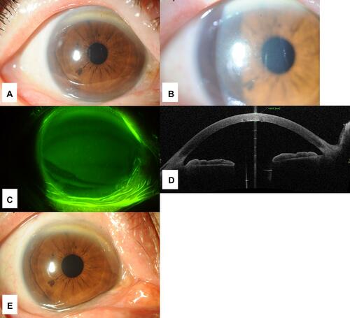 Figure 5 Clinical findings of the anterior segment at the first visit for case 4. (A) Photograph of the anterior segment of the right eye. Hyperemia was not observed. (B) Photograph of slit-lamp examination of the right eye. Folds of Descemet’s membrane were observed. (C) Photograph of the cornea after the use of fluorescein. Corneal epithelial defect was not observed. (D) Optical coherence tomography image of the anterior segment. Paracentral corneal thickness was 625 μm and corneal edema was observed. (E) Photograph of the anterior segment after the treatment. The folds of Descemet’s membrane disappeared.