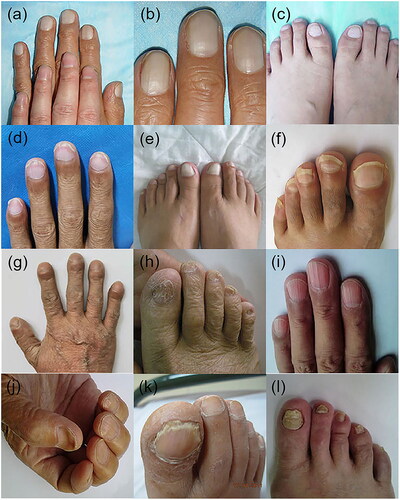 Figure 2. Nail changes in patients with chronic liver disease. (a–c) Terry’s nails, (d) Lindsay’s nails, (e) leukonychia, (g) clubbing nails, (f) onycholysis, (h) brittle nails, (i) longitudinal striations, (j) koilonychia, (k, l) onychomycosis.