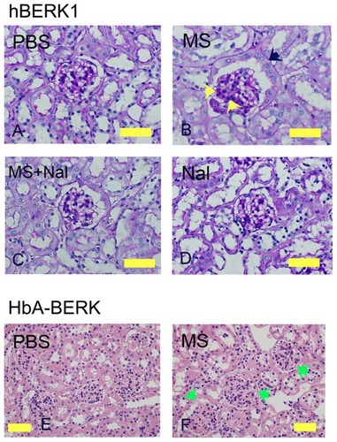 Figure 2 Morphine treatment exacerbates renal pathology in hBERK1 and HbA-BERK mice. (A–D) PAS-stained kidney sections from hBERK1 mice treated with morphine and/or naloxone for 6 weeks. Note the glomerular enlargement, increased mesangial cell density (black arrow), and parietal cell metaplasia (green arrow) in (B).