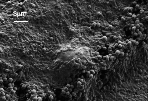 Figure 2 SEM image showing an undifferentiated HL60 human monocytic cell which has come up against a wall of P. aeruginosa and S. aureus cells co-cultured in a biofilm grown in vitro.