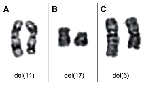 Figure 5 Partial karyotypes showing recurrent chromosomal deletions in CLL. (A) Chromosomal pair 11 from a CLL showing a del(11)(q22). (B) Chromosomal pair 17 from a CLL showing a del(17)(p12). (C) Chromosomal pair 6 from a CLL showing a del(6)(q13q22).