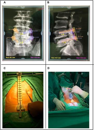 Figure 2 The procedures of robotic surgery. The surgical technique was combined with a secondary registration during surgery to increase the accuracy of pedicle screw placement, guided with a bone-mounted miniature robot system. (A and B) Preoperative planning: preoperative computed tomography images are converted to three-dimensional reconstruction images, and the best trajectory and appropriate size of screw, including the diameter and length, are decided on the working station of the robotic system. (C) Attachment to the patient’s spine: The bone-mounted frame is applied and fixed on the patient’s spine firmly. (D) Robot packaging and initiation: The robot is attached to the bone-mounted frame. Appropriate channel for the robot attachment is decided by the system, allowing the robotic arm to operate according to the preoperative plan. Drilling implementation: A guiding tube is inserted to the entry point of the pedicle screw along the trajectory decided by the robotic arm. Drilling along the guiding tube is subsequently performed by a surgeon, and then a Kirschner-wire is inserted along the drilling tract.