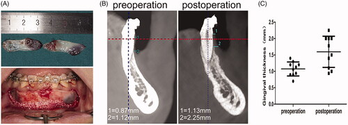 Figure 1. CGF could lead to thickened gingiva after PAOO in patients with thin gingival biotype. (A) The CGF membrane was used during PAOO. (B) The measurement of gingival thickness before and 6 months after PAOO. (C) The quantitative assay for the gingival thickness before and 6 months after PAOO.