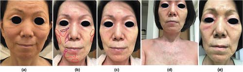Figure 1. An anaphylactic reaction after simultaneous injection of hyaluronic acid fillers and human collagen.