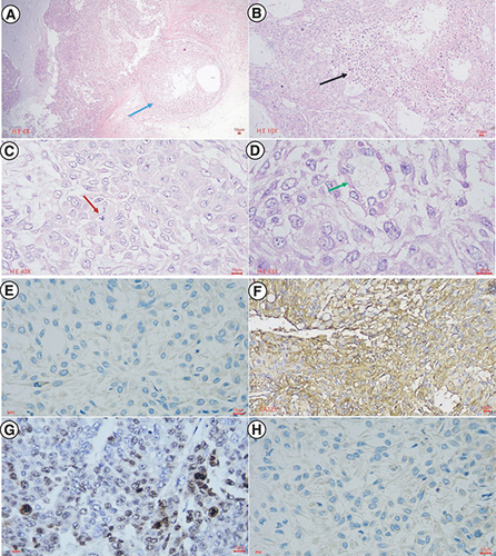 Figure 5. Histopathological characteristics of secondary tumor resected from BALB/c mice.The central part of the primary tumor for histopathology, avoiding the area of gross hemorrhagic necrosis. In Hematoxylin-Eosin staining (A–D), at the low power field, the tumor invades the fibrous capsule (blue arrow), and central necrosis is extensive (black arrow). At the high power field, the tumor shows high cell density, epithelial cells with tight adhesion to each other, in some places similar to glandular or cystic structures (green arrow), polygonal in shape and some cytoplasms with light cavities. High nuclear/cytoplasmic ratio, round or oval nucleus, rough chromatin, and abnormal nuclei mitosis (red arrow). In immunohistochemical staining (E–H), malignant cells showed negative nuclear staining with WT1, strong and diffuse membranous staining with CA125, nuclear staining with Ki67 accounted for 60%, and the complete absence of staining with p53.