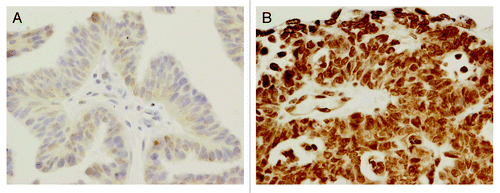 Figure 1. p19INK4d protein expression in two different ovarian carcinomas (400× , hematoxylin counterstain): (A) low p19INK4d expression, (B) high p19INK4d expression.