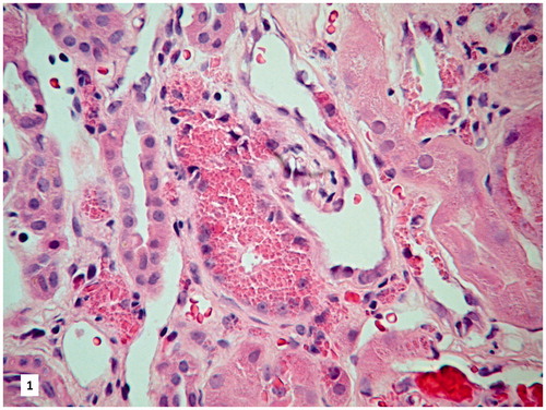 Figure 1. Eosinophilic, crystalloid deposits localized in the cytoplasm of PTEC (HE staining, original magnification 200×).