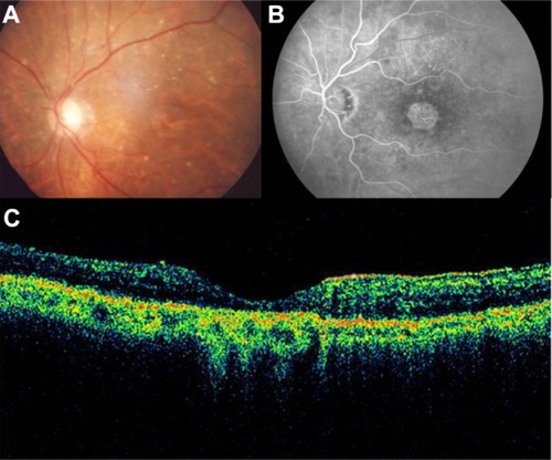 Figure 1 (A) Color fundus photograph of geographic atrophy, secondary to age-related macular degeneration, showed a rounded, depigmented area with well-defined margins. (B) Fluorescein angiography demonstrated hyperfluorescence due to a window defect. (C) The Stratus optical coherence tomography image showed backscatter in the zones of atrophy, with marked hyperreflectivity and retinal thinning in the entire zone of atrophy.