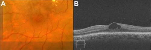 Figure 52 (A) Color fundus photograph of localized parafoveal telangiectasis. (B) Cirrus™ optical coherence tomography image shows an intraretinal cyst as a low-reflective intraretinal area, secondary to the parafoveal telangiectasis.