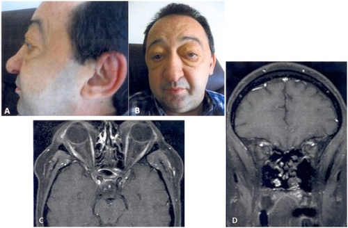 Figure 4 Six months of treatment. Significant regression of eyelid swelling (A, B). Follow-up MRI: axial (C) and coronal (D) contrast-enhanced fat-suppressed T1-weighted MR images shows normalization of eyelid, lateral rectus oculomotor, masticatory and temporal muscle.