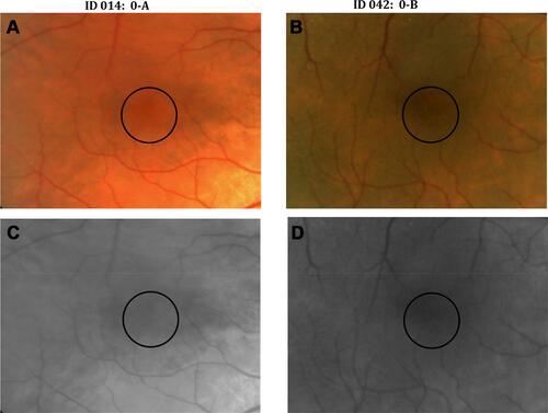 Figure 2 Images from same eyes as shown in Figure 1 under high magnification (A, B) and under gray scale (C, D) to better visualize the minimal macular changes seen in subject ID 042. The black circle indicates the region in the macula where fundus retinal changes were observed.