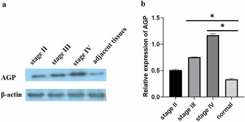 Figure 2. Expression of AGP in breast cancer tissues and adjacent normal tissues using Western blot analysis. (a-b). Western blot analysis was performed to evaluate AGP protein expression at different stages of breast cancer: early-stage (stage II), middle-stage (stage III), late-stage (stage IV), and adjacent normal tissue. The relative expression of AGP in stage III and stage IV was significantly higher than that in normal tissues (*P < 0.05).