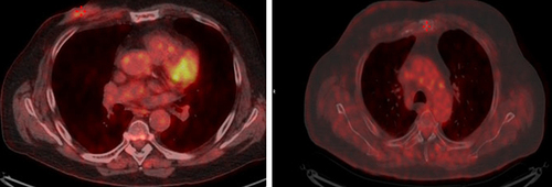 Figure 10 PET FDG evaluation.