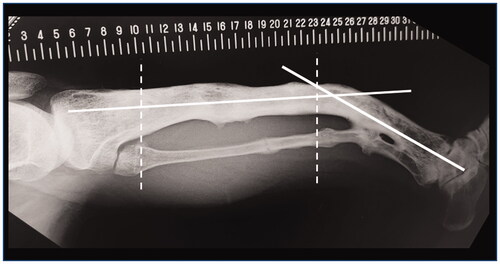 Figure 2. The standard lateral radiograph of the left lower leg. White solid lines indicate the apparent location of the tibial anatomical axes. Two white dashed lines indicate approximate location of two inflection points in the AP view.