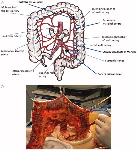 Figure 5. James Lawson Drummond (1783–1853) was an Irish physician, naturalist and botanist. (A) Drummond marginal artery is a continuous arterial arcade along the inner border of the colon formed by the anastomoses of the terminal branches of the superior mesenteric artery (SMA) and the inferior mesenteric artery (IMA). Asterisks mark the critical points of Griffiths at the splenic flexure and the critical point of Sudeck at the recto-sigmoid junction (the site of the anastomosis between the sigmoid and superior rectal arteries). (B) The marginal artery is clearly visible in the intra-operatory backlit picture.