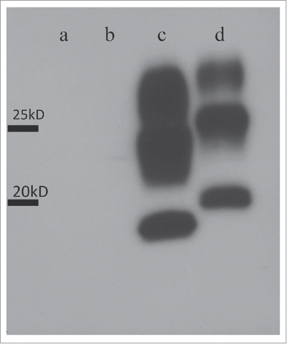 Figure 6. Western blot analyses of frozen brain extracts using 3F4 antibodies. Lane a: a sample from the present case (the frontal lobe); Lane b: a sample from the present case (the thalamus); Lane c: a control sample from a case of MM2-thalamic-type sporadic Creutzfeldt-Jakob disease (sCJD) case (the thalamus); Lane d: a control sample of MM1-type sCJD case (the frontal lobe).