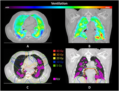 Figure 1. Definition of functional lung volumes.A + B: Functional lung mapping (A + B) giving shape to the functional lung volume (FLV);C + D: Projection of the treatment plan isodoses in relation to the FLV.