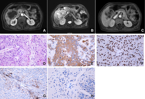 Figure 3 Radiographical findings and pathological reports for case 3. MRI revealed a large mass in the right lobe of the liver, with a long T1 and long T2 signal, a high signal in DWI, and a low signal in ADC (A–C). Pathological report revealed a diagnosis of SCC (D). The IHC analysis showed positive staining of CK5/6 (E) and P63 (F). PD-L1 expression on tumor cells was 30% (G), and its expression on tumor-associated immune cells was 10% (H).