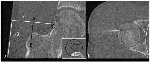 Figure 1. (a) Sagittal CT image of an OO located in the neck of femur (circle). The nidus is sclerotic. There is no need to protect any surrounding structures during ablation (group (a)). L corresponds to the diameter of the transducer (L/2 = 50 mm) and d to the distance between the focal point and the skin (d = 61 mm). The plane perpendicular to d and containing AB is shown in the bottom right of figure (a): in this case, 12% of the US beam would be obstructed by the great trochanter. (b) Axial CT image illustrating laser ablation of the OO. A 14-gauge penetration set was used to drill the nidus. The laser fiber was inserted coaxially in an 18-gauge spinal needle (arrow).