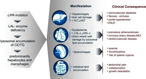 Figure 3 Development of the clinical manifestations in LAL-D. Although the mechanisms are universal as depicted in the sequence of events on the left, clinical manifestations and consequences range from liver disease to atherosclerosis and malabsorption.Abbreviations: LAL, lysosomal acid lipase; CE, cholesteryl esters; TG, triglycerides; ALT, aspartate transaminase; AST, alanine aminotransferase; LDL-c, low-density lipoprotein cholesterol; HDL-c, high-density lipoprotein cholesterol; ESLD, end-stage liver disease; MCI, myocardial infarction.