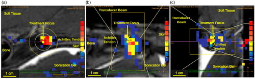 Figure 5. T2-weighted MRI image of the Achilles tendon with proton Resonance frequency shift MR thermometry (PRFS-MRT) at the end of MRgFUS sonication showing the maximum temperature achieved during sonications. Temperature mapping corresponds to the scale displayed on the right for PRFS-MRT in (a) sagittal, (b) axial, and (c) coronal views.