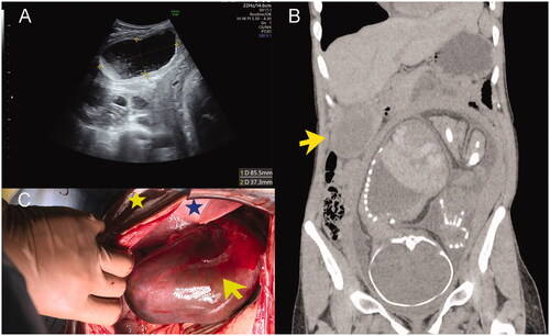 Figure 1. Imaging and intraoperative findings in this case. (A) Ultrasonography shows a distended gallbladder with thickened walls and debris storage without stones. (B) Coronal computed tomography shows a distended gallbladder (yellow arrow) with thickened walls, located outside the hepatic bed. (C) The yellow star indicates the cephalic side. Intraoperative findings show a distended, gangrenous gallbladder (yellow arrow) floating from the liver (blue star) with a 360° clockwise torsion around the cystic duct.
