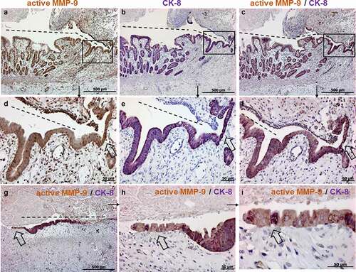 Figure 5. Representative images of immunohistochemistry staining results for active (a, d), CK-8 (b, e) and double staining for active MMP-9/CK-8 (C, F-I) in human xenograft fistulas (n = 6). The histology of the human xenograft fistula is similar to the human fistula. TC are found positive in the single staining for MMP-9 (a) and CK-8 (b) and in the co-staining MMP-9/CK-8 (c, g) at the tip of the fistula. Figures A, B, C are consecutive sections with higher magnifications found in D-F. Figure G shows TC from a different specimen with enlargements shown in H, I. Single stained and doubled stained cells with nuclei stained with hematoxylin are recognizable (i). Dashed line indicates the fistula tract. Small arrows indicate enlargements. Large arrows indicate TC.