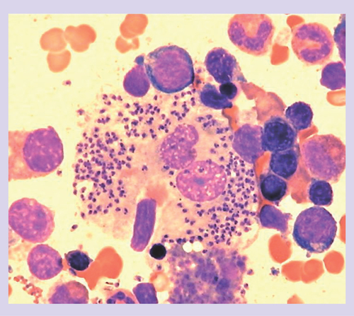 Figure 1. Bone marrow aspirate smear showing a heavily parasitized macrophage containing numerous intracellular amastigotes