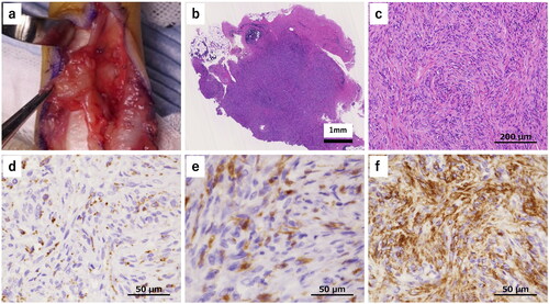 Figure 2. Intraoperative findings and histopathological findings (hematoxylin and eosin staining, and immunohistochemical staining). a A yellowish-red mass was detected which was easily dissected from the skin and the tendon sheath. The mass strongly adhered to the neurovascular bundle on the ulnar side. b The tumor was relatively well circumscribed. c The lesions had high cellular density rather than fibrous tissues, with spindle-shaped cells in a storiform pattern. d CD68 was positive in spindle- shaped cells and it presented granular cytoplasmic pattern. e Factor XIIIa was also positive in spindle-shaped cells. f α-SMA was positive in the majority of spindle-shaped cells.