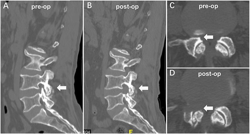 Figure 2 Percutaneous endoscopic transforaminal decompression performed on a 63-year-old male patient diagnosed with lumbar spinal stenosis. (A) Preoperative computed tomography on sagittal scans. The white arrow indicates preoperative foraminal stenosis on sagittal scans. (B) Postoperative computed tomography on sagittal scans. The white arrow indicates postoperative foraminal enlargement on sagittal scans. (C) Preoperative computed tomography on axial scans. The white arrow indicates preoperative foraminal stenosis on axial scans. (D) Postoperative computed tomography on axial scans. The white arrow indicates postoperative foraminal enlargement on axial scans.