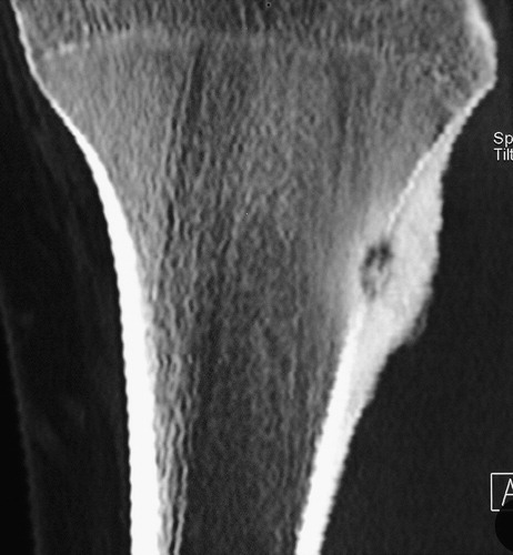 Figure 2. Preoperative CT scan of an osteoid osteoma lesion of the proximal medial tibia.