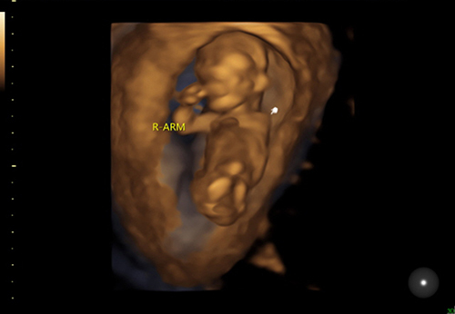 Figure 2 Three-dimensional ultrasound: the left upper limb of the fetus is not visible (indicated by the white arrow).