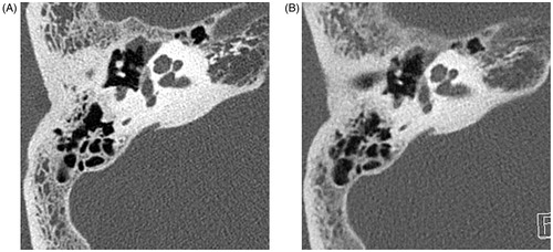 Figure 2. Images from ultra-high-resolution CT (A) and conventional high-resolution CT (B) of the same patient. A. U-HRCT image (0.25-mm slice thickness) in the lateral semicircular canal plane. Decreased HU value in the fissula ante fenestram and stapes was noted. B. HRCT image (1-mm thickness) in the lateral semicircular canal plane. This image was obtained 3 months before A at another hospital. Lesions at the stapes and fissula ante fenestram are not clear on this image.