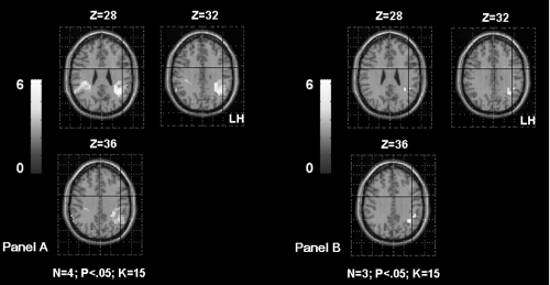 Figure 4 Shows the supramarginal gyrus (SMG) activation in TLE patients according to the age of seizures onset. The Panel A shows bilateral SMG activation in patients with seizures starting before age of 6 years old (OC, SDi, PD, CG from Table 1). The Panel B shows left SMG activation in patients with seizures starting after age of 6 years old (MR, FD, SD from Table 1). The activation is projected onto 2D anatomical slices (left is right).