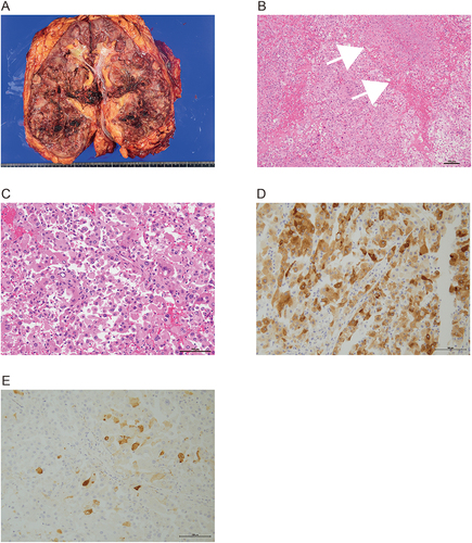 Figure 2 Macro (A), microscopic appearance (B and C) and immunohistochemical findings (D–F) are shown: tan-brown colored renal tumor, 15×10 cm in size with hemorrhage and necrosis located in the lower pole of the kidney (A). Necrosis was observed (white allows, (B). Tumor cells with severe atypia and eosinophilic cytoplasm proliferated in papillary architecture (C). The cells were positive for Melan A (D) and cathepsin K (E) in immunohistochemistry. Scale bars: 100 μm.