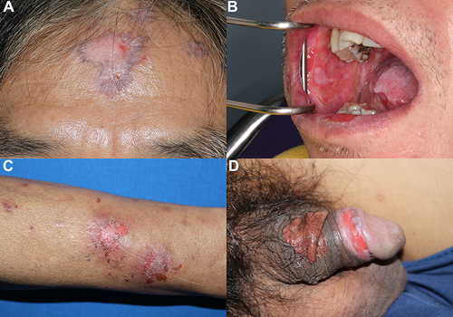 Figure 1 Clinical manifestations of PNP on the forehead (A), oral mucosa (B), left forearm (C) and genitalia (D).