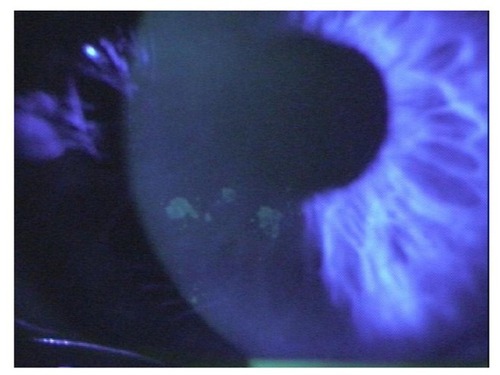 Figure 2 Confluent superficial punctate keratopathy in the eye of a diabetic patient.